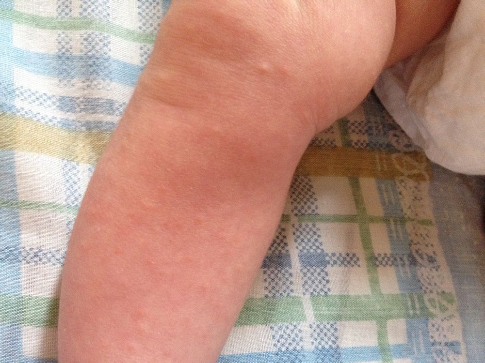 宝宝腿上起了好多小疙瘩