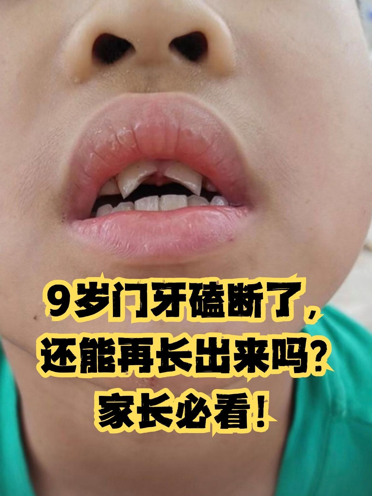 门牙磕掉了一小块可以修补吗