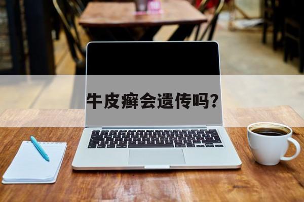 牛皮癣会遗传吗？